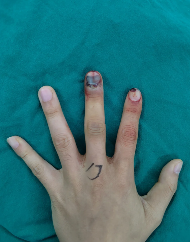 手指挫伤,怎么办?