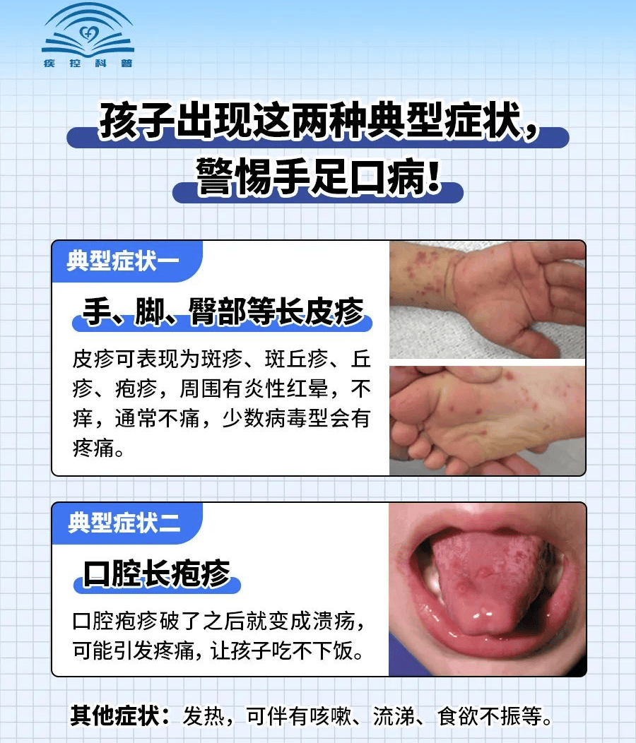 手足口病和疱疹的区别