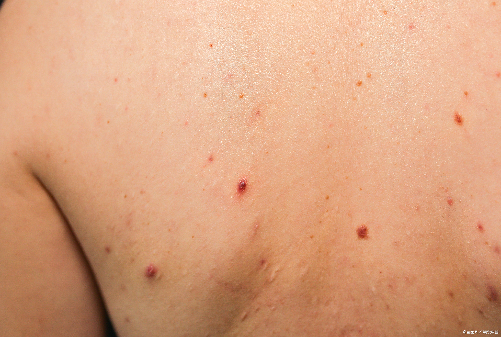 后背起疙瘩是怎么回事