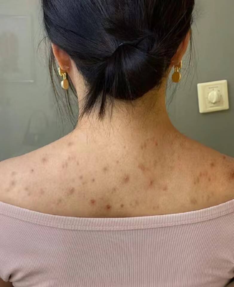 后背起疙瘩是怎么回事