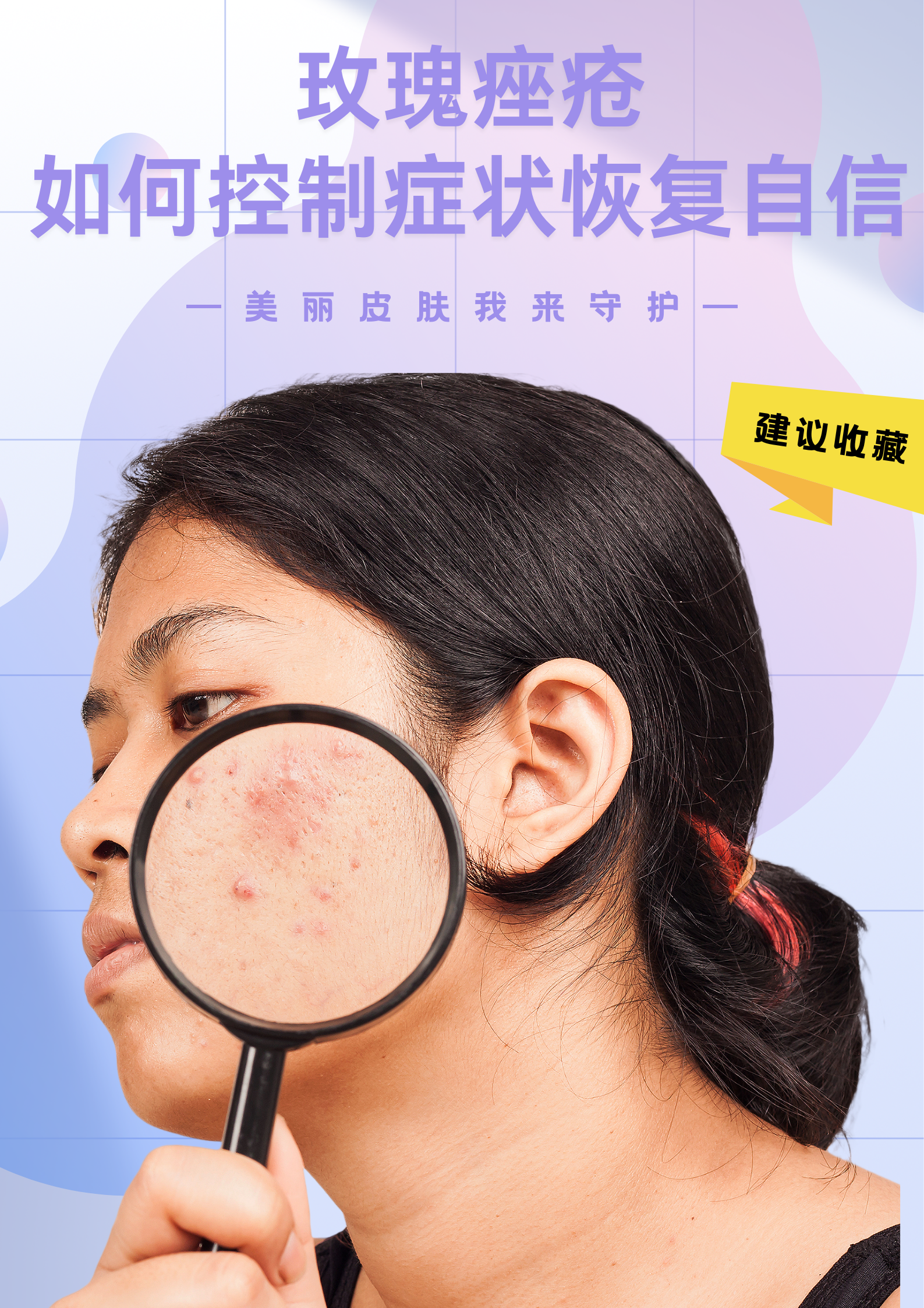 玫瑰痤疮可以自愈吗