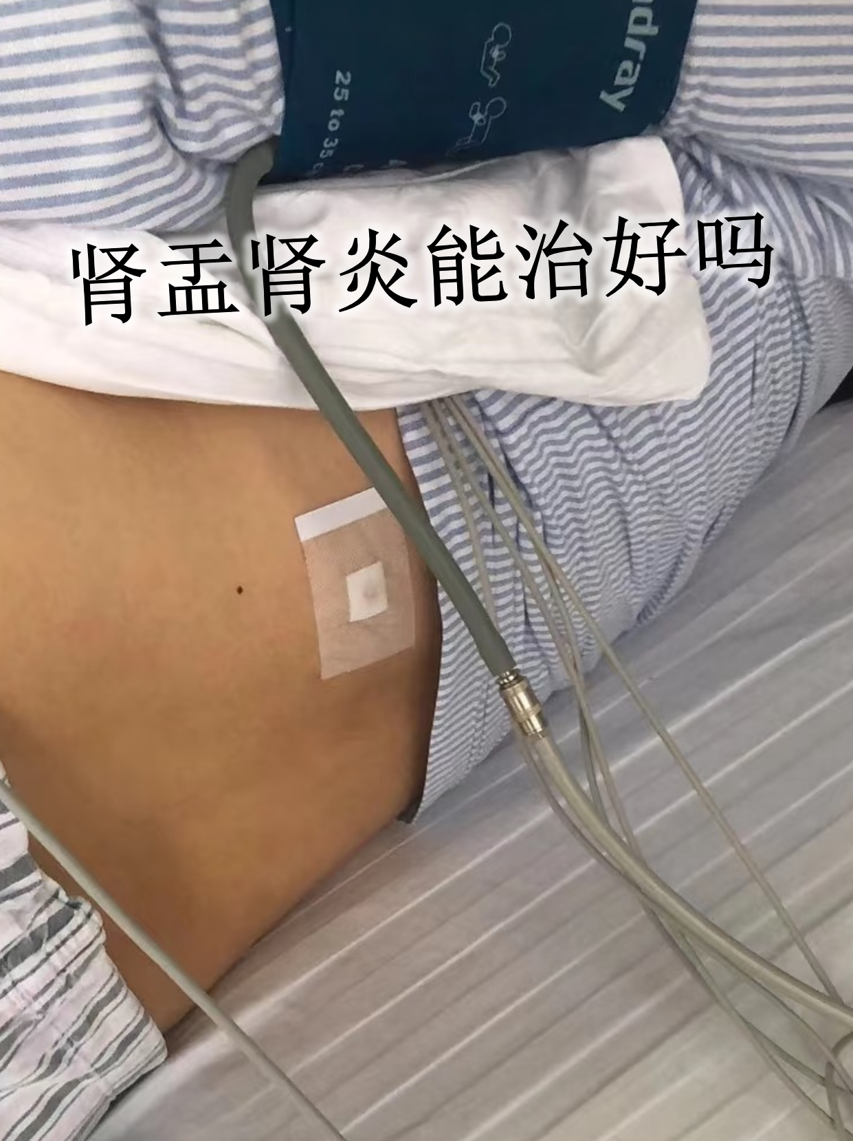 肾炎可以治好吗?