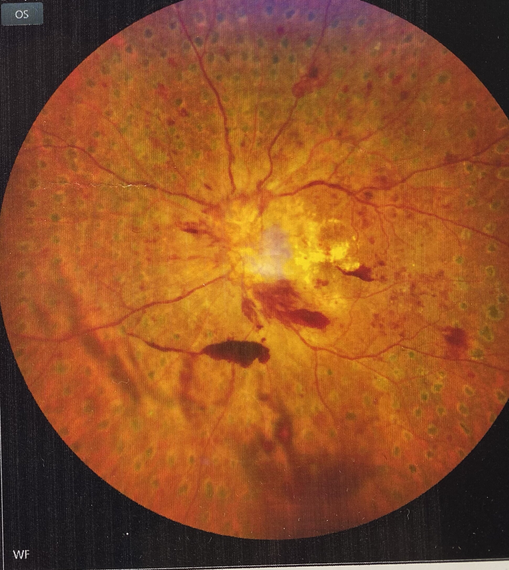 什么是糖尿病眼底病变