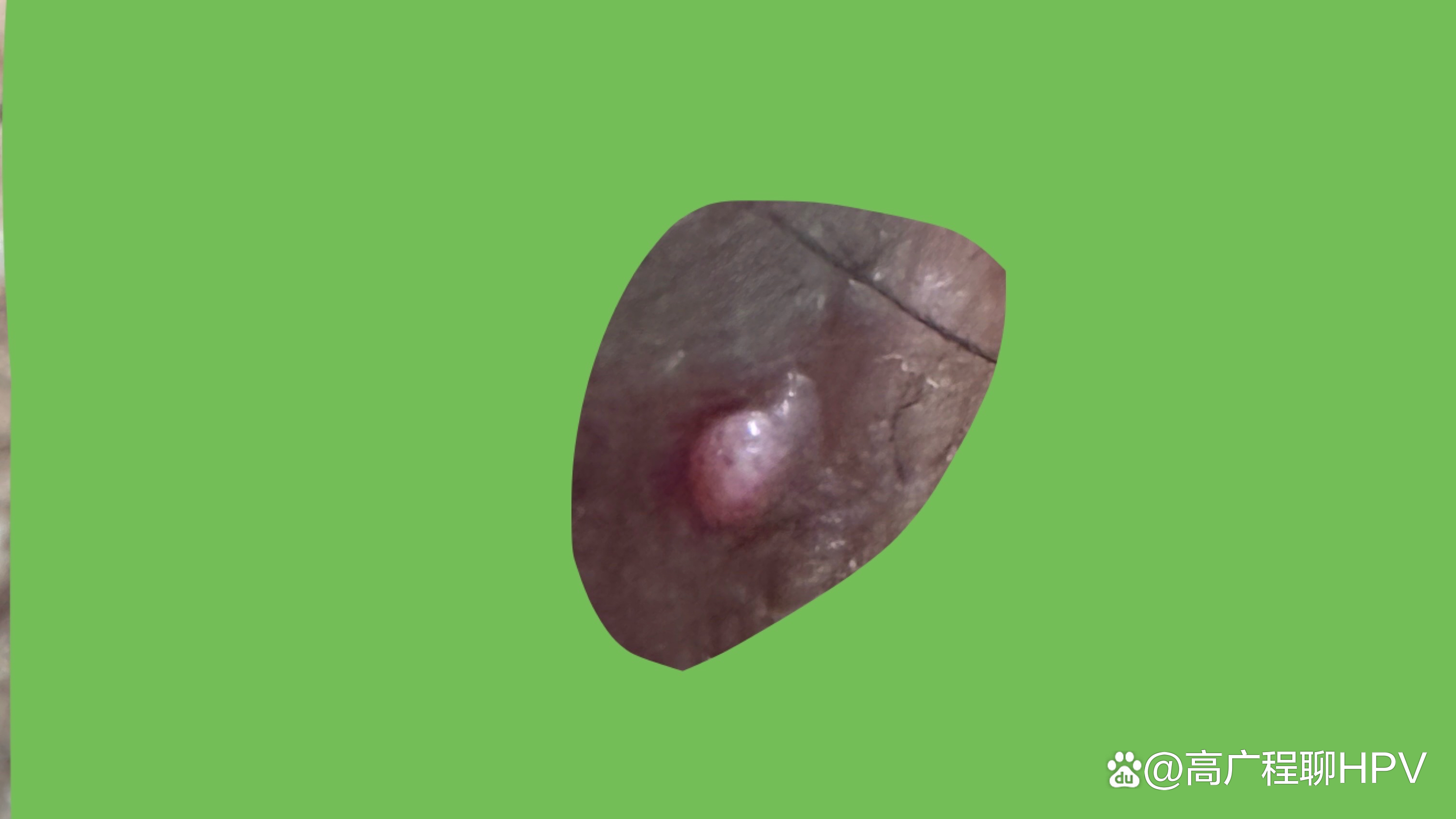 肛门周围有肉疙瘩,是怎么回事