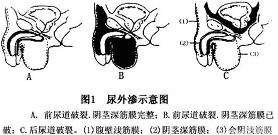 后尿道损伤的临床表现