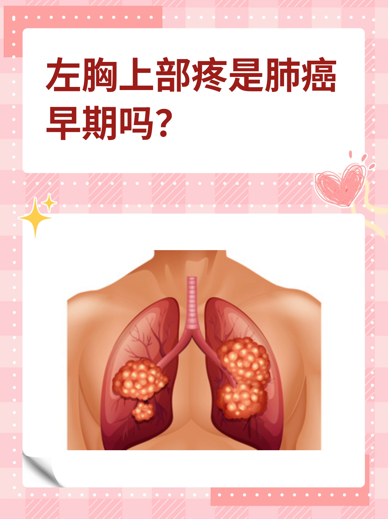 肺癌早期症状有哪些?