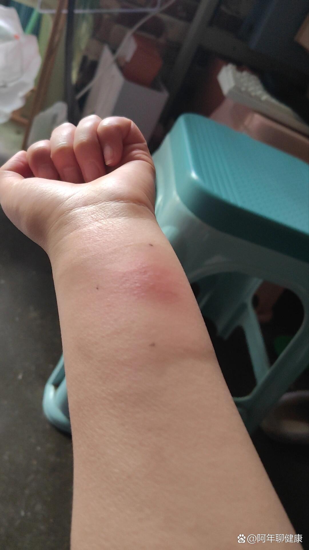 肺结核皮试结果怎么看