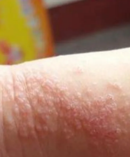 手上起小红点怎么回事