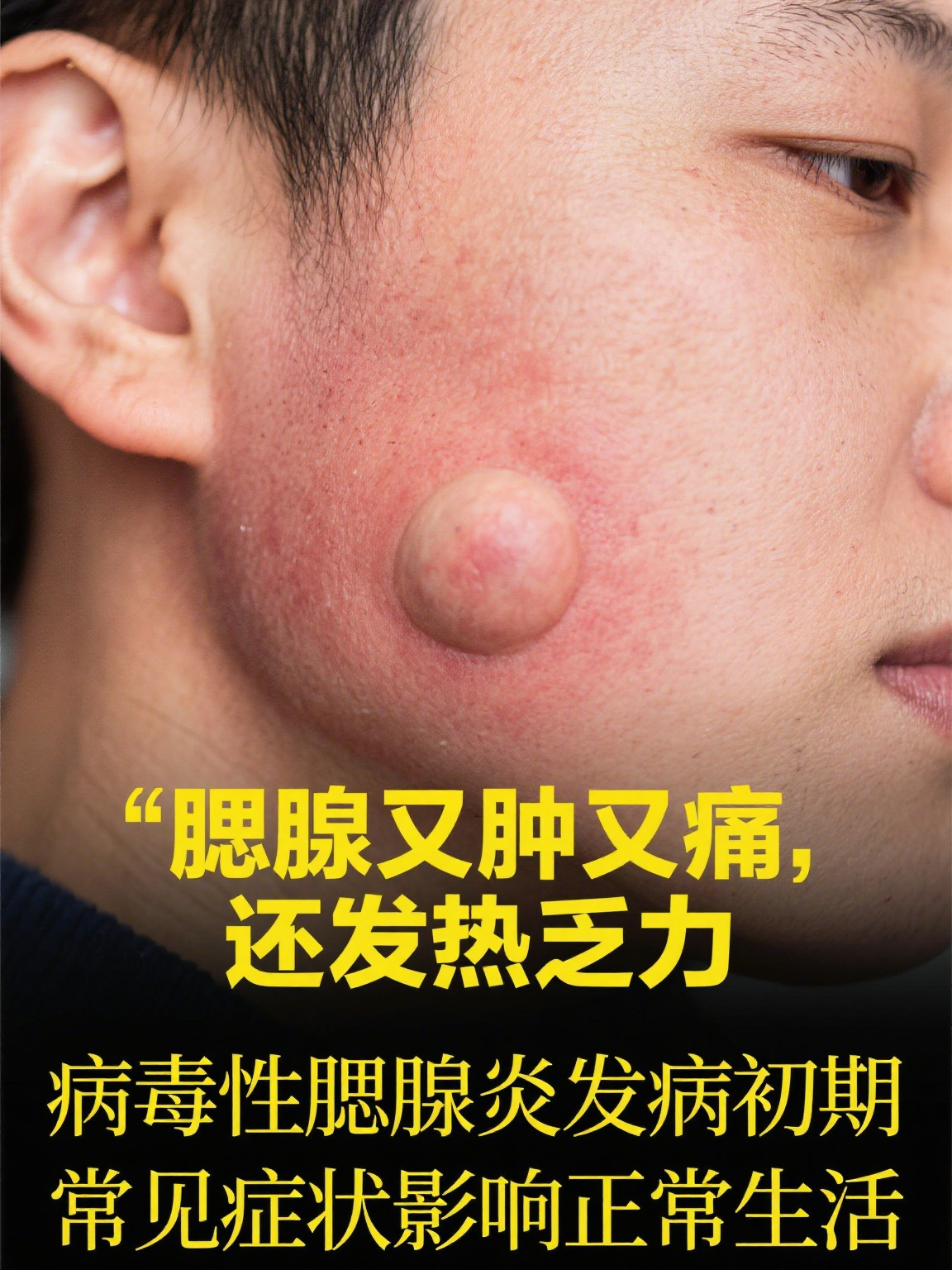 腮腺炎如何治疗