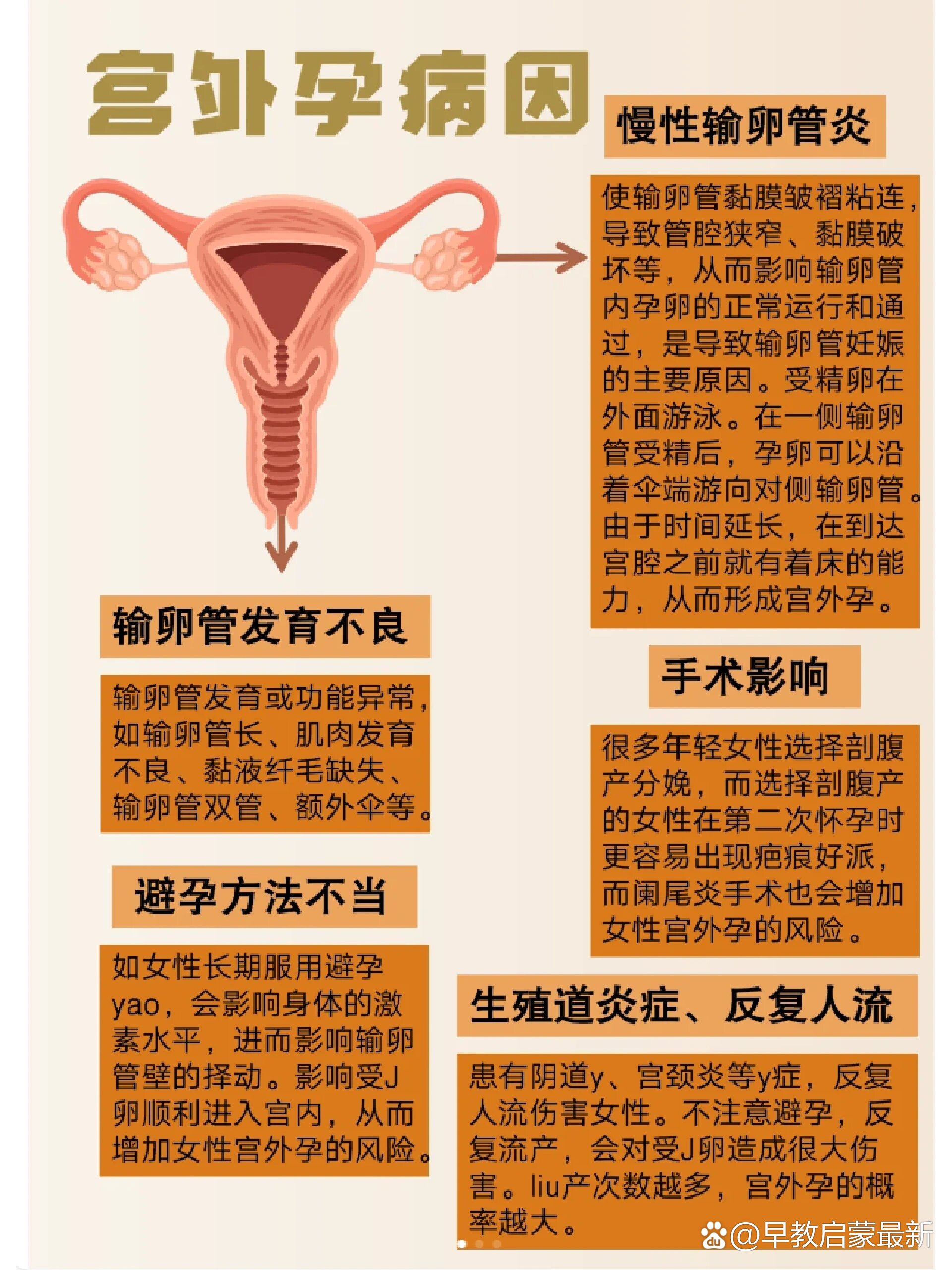 宫外孕会自然流产吗