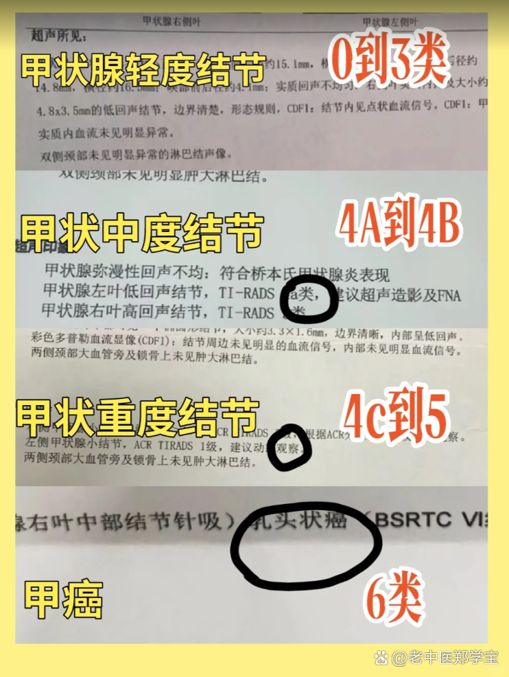 甲状腺结节3类严重吗