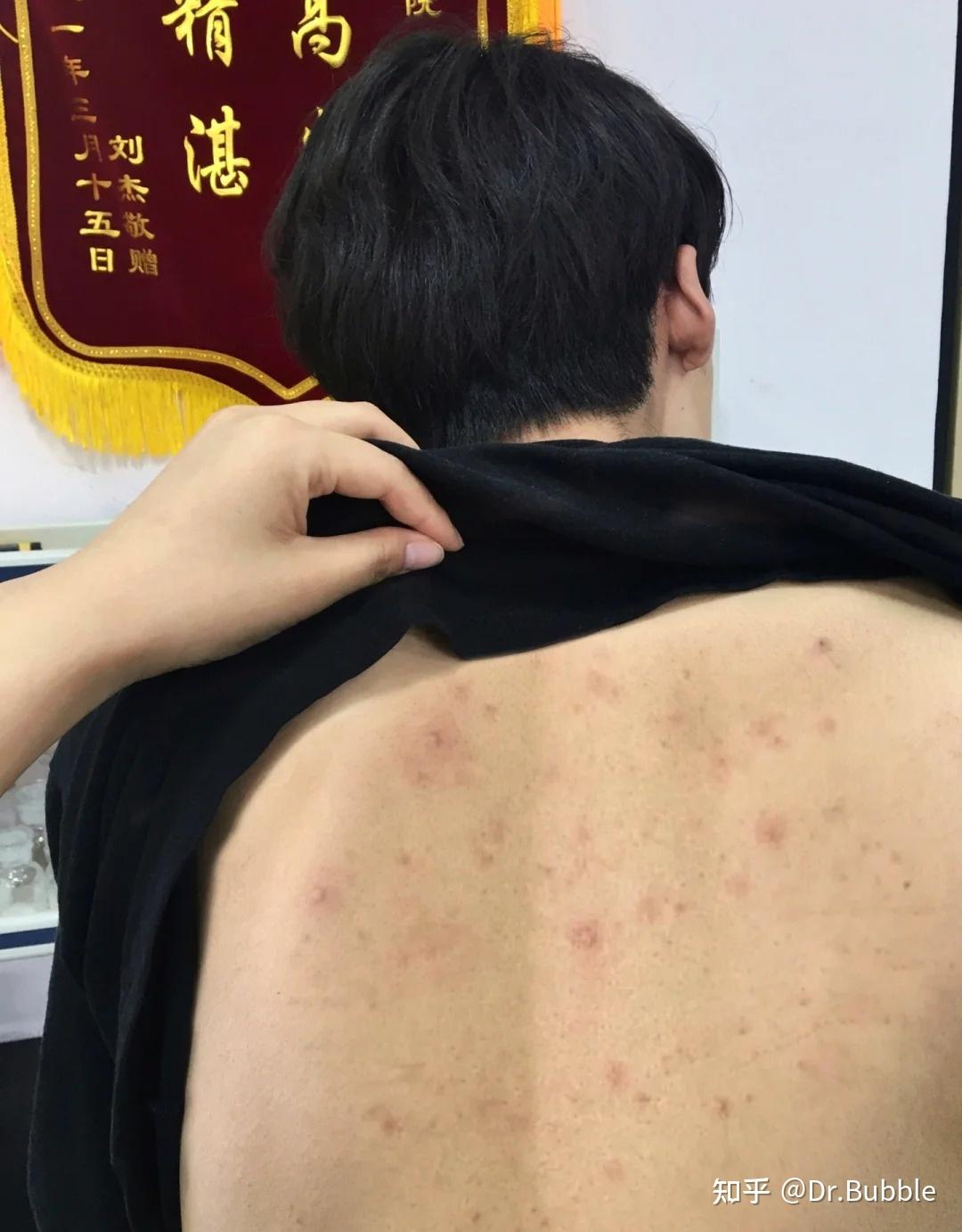 金黄色葡萄球菌引起的毛囊炎