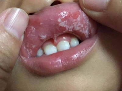 小孩口腔疱疹有什么症状表现