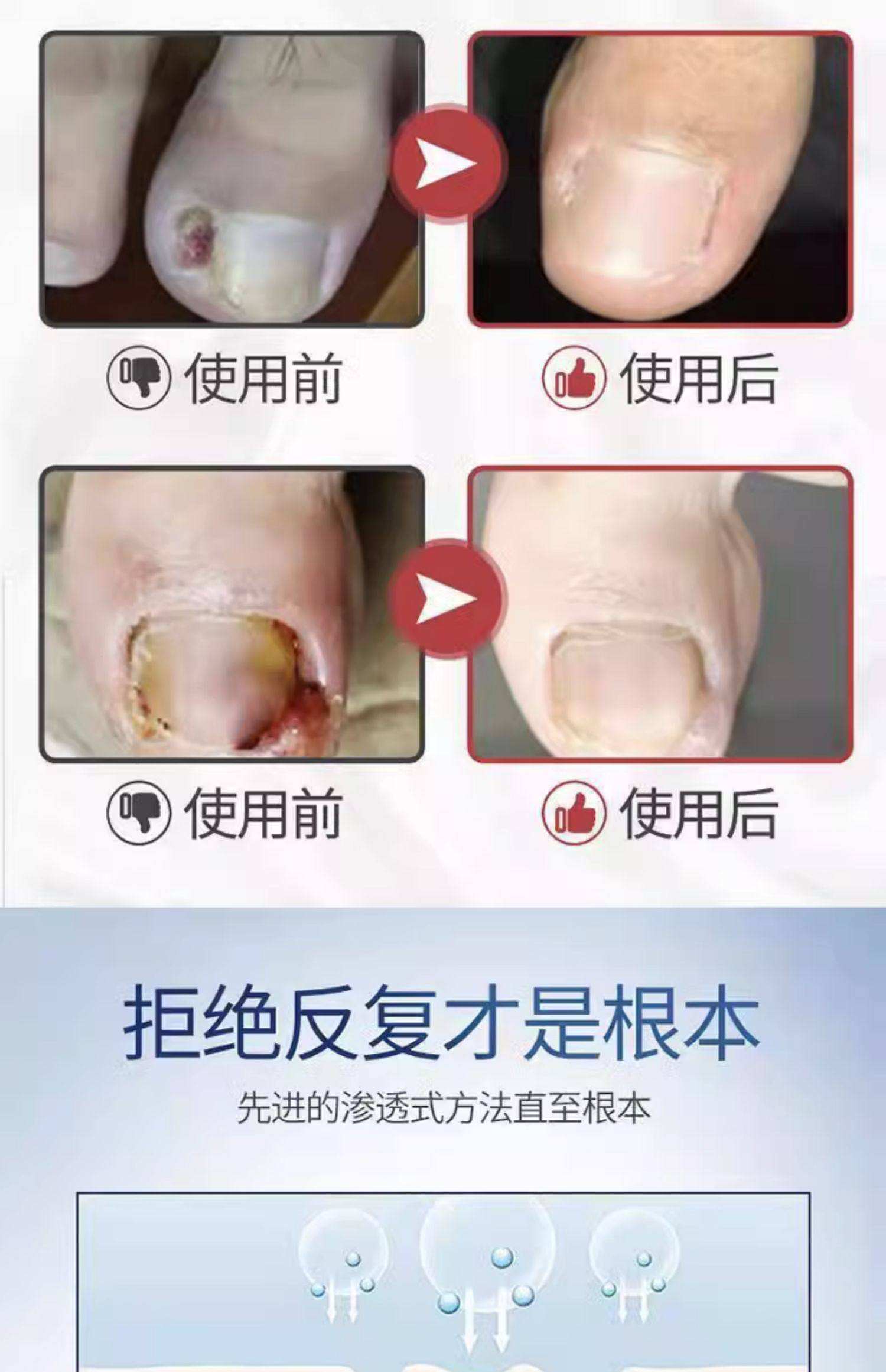 甲沟炎会自愈吗