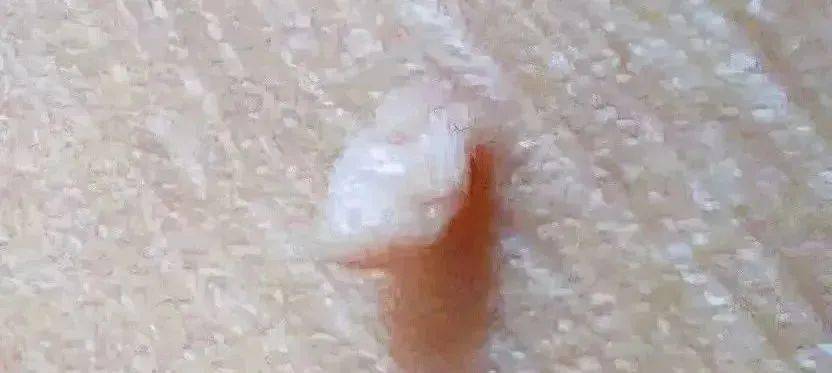 外阴长了一个痘痘怎么处理