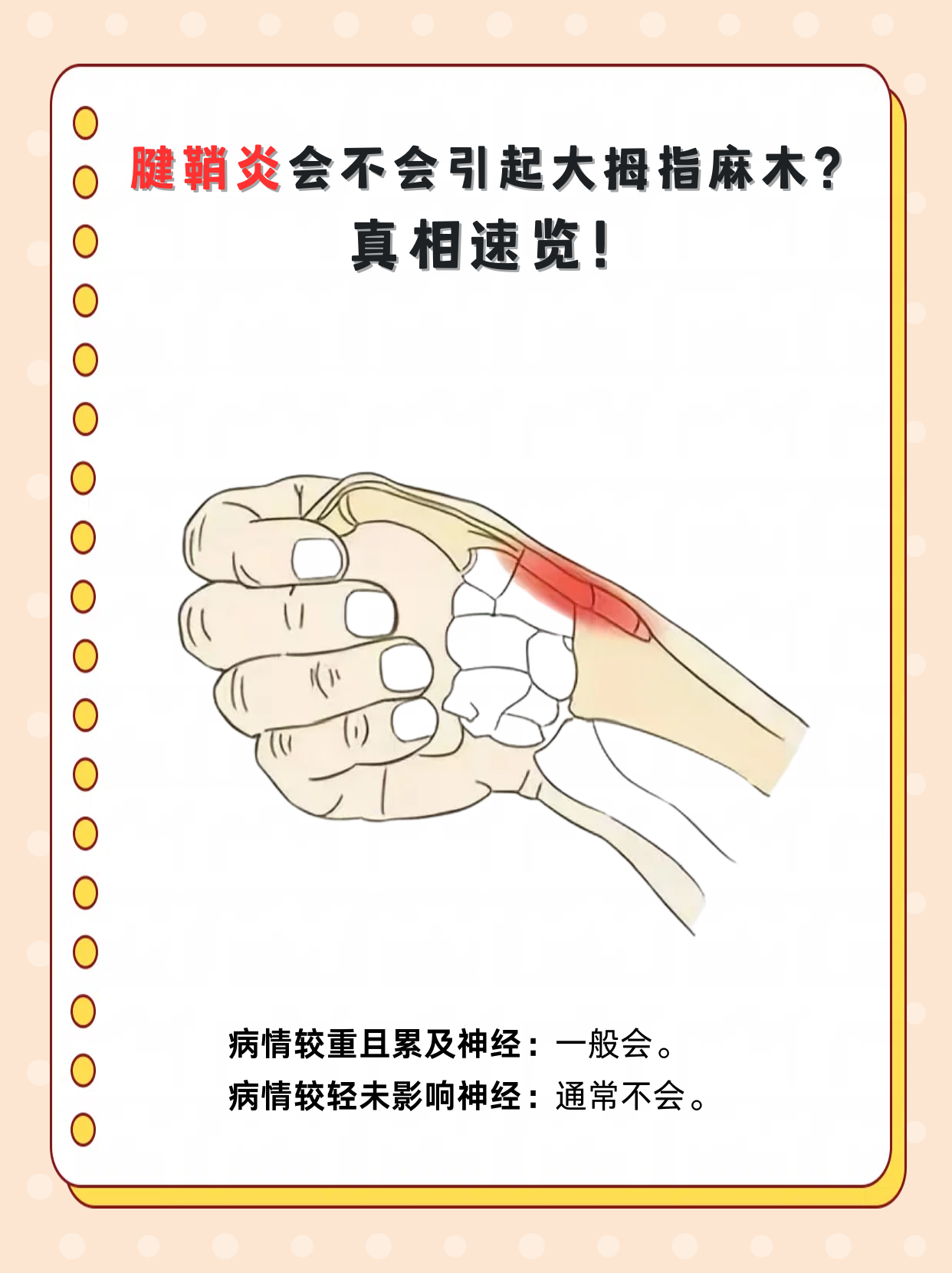 大拇指腱鞘炎有哪些表现