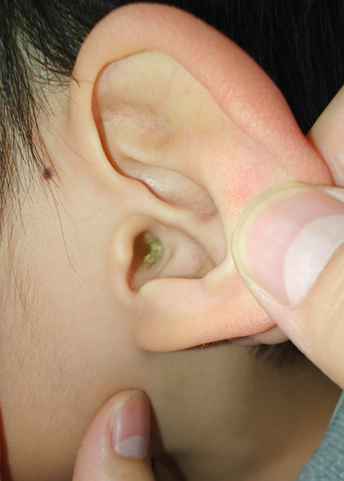 单侧耳朵闷塞感是怎么回事