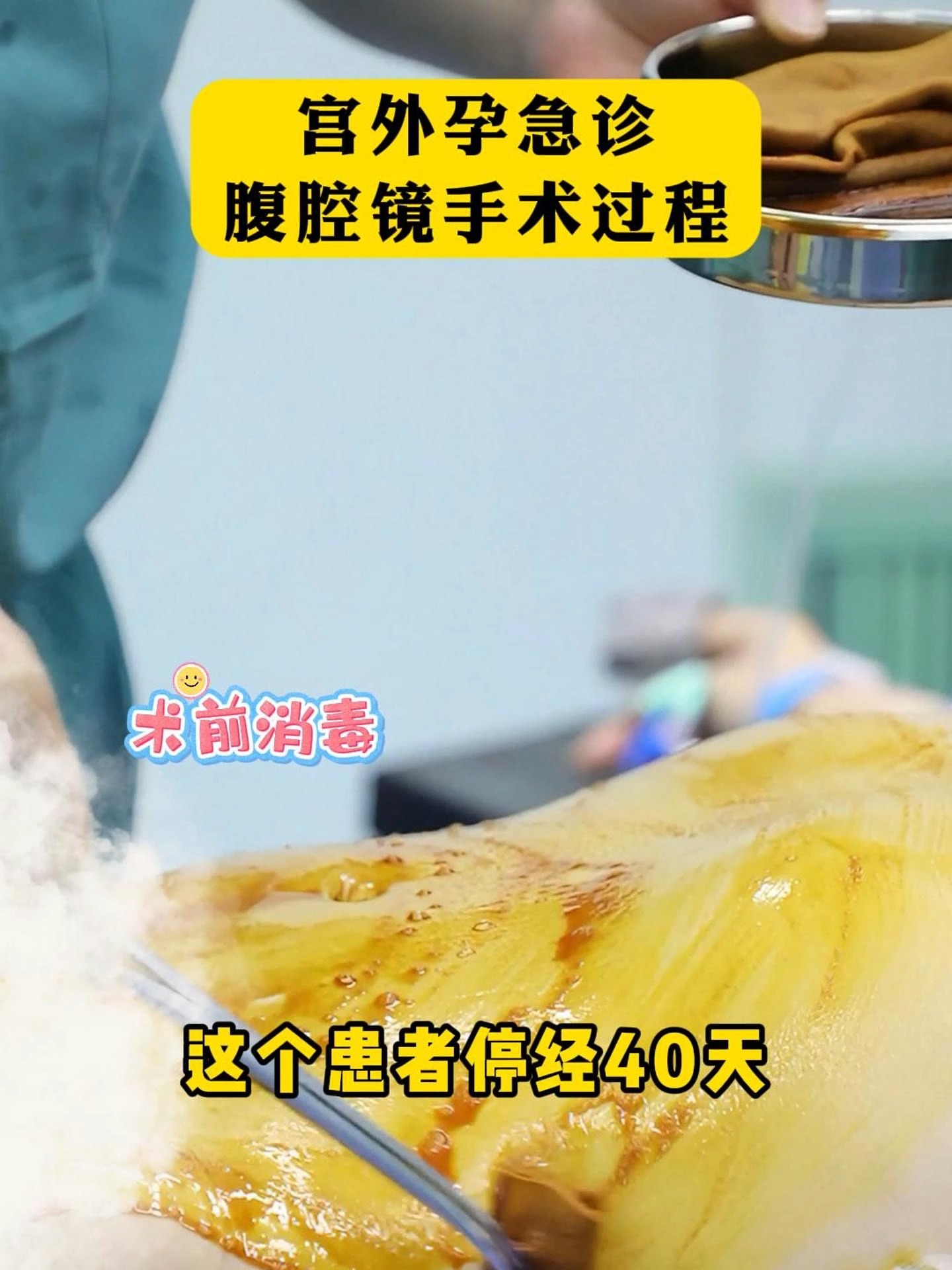 宫外孕手术要住院吗