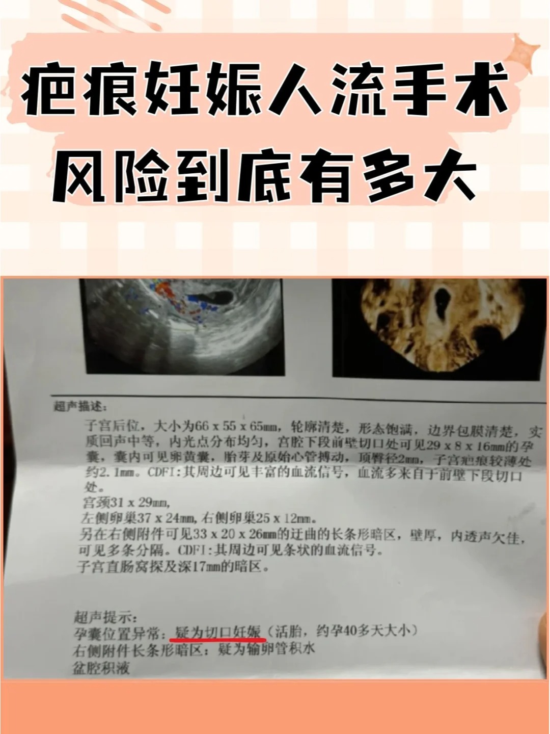 腹腔妊娠的诊断标准