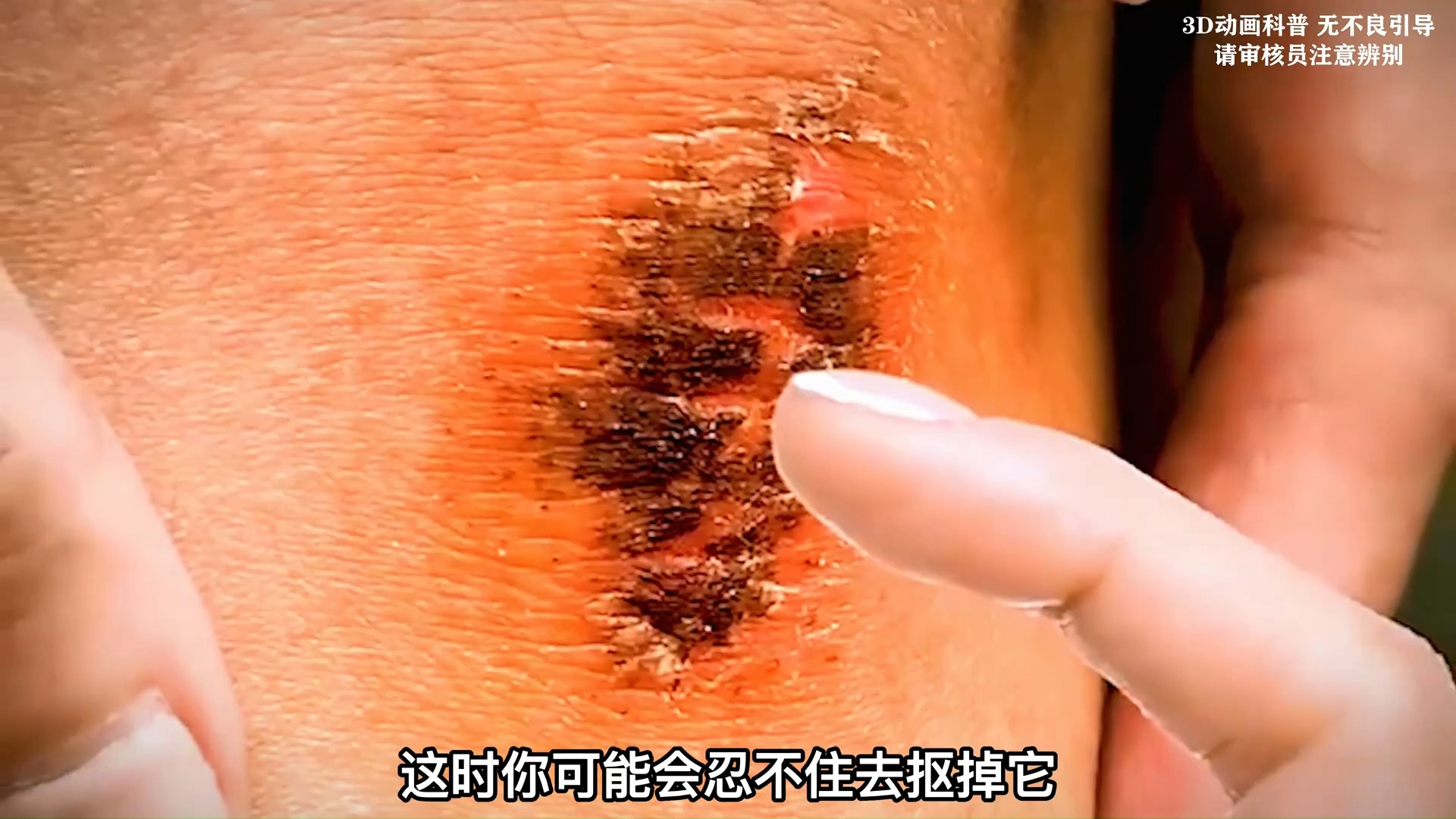 结痂的伤口可以碰水吗?