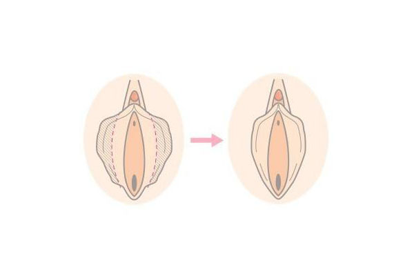 阴道整形有什么讲究?