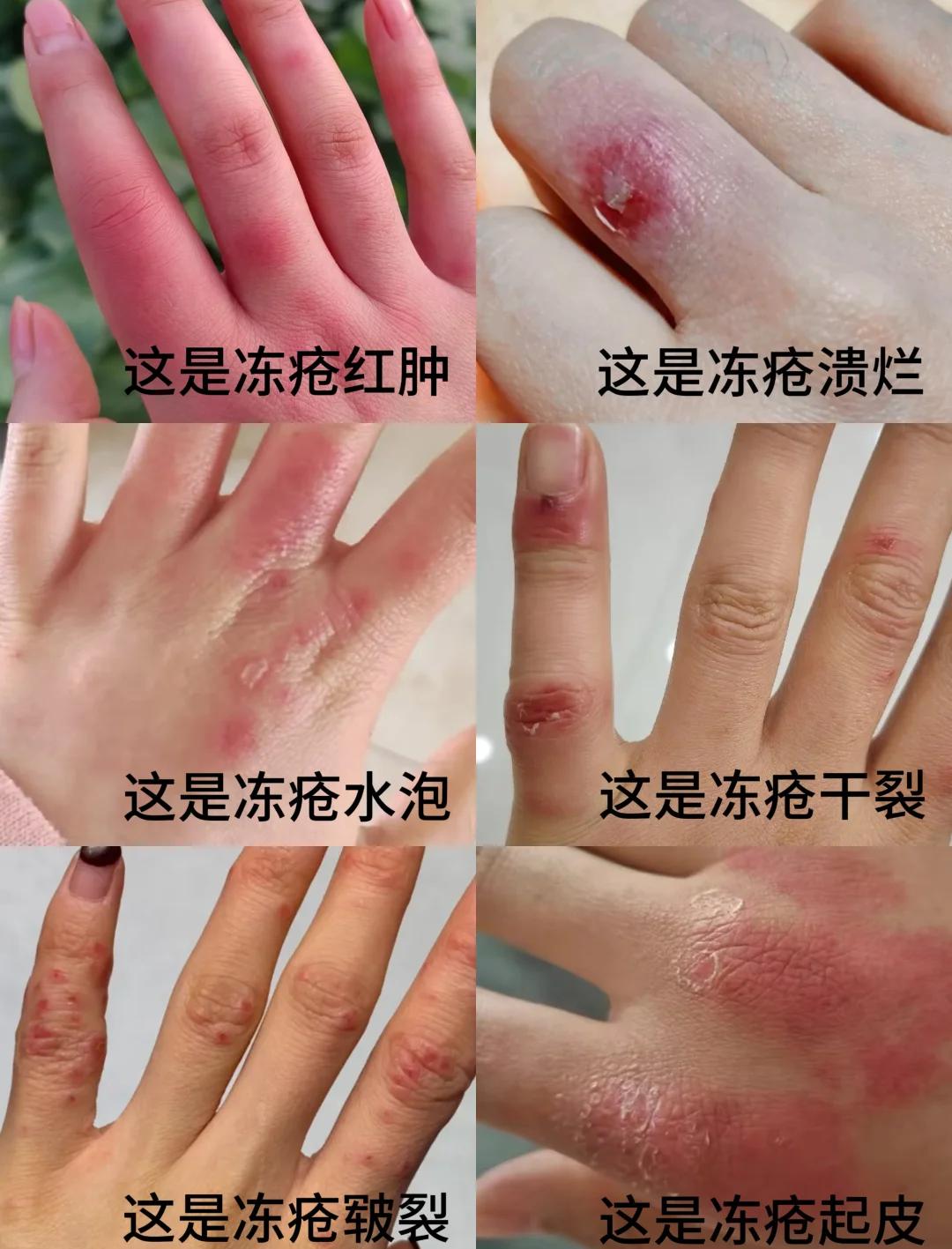 冬天手被冻肿了怎么办