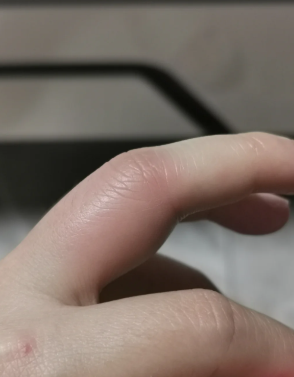 手摔肿了怎么消肿