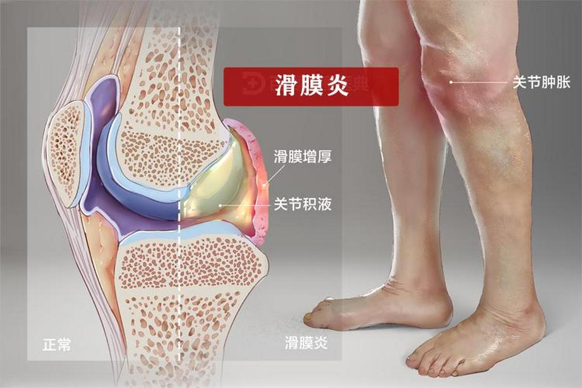 髌上囊积液多久会病变?