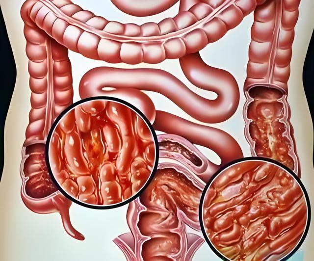 大便暗红色血是肠癌吗