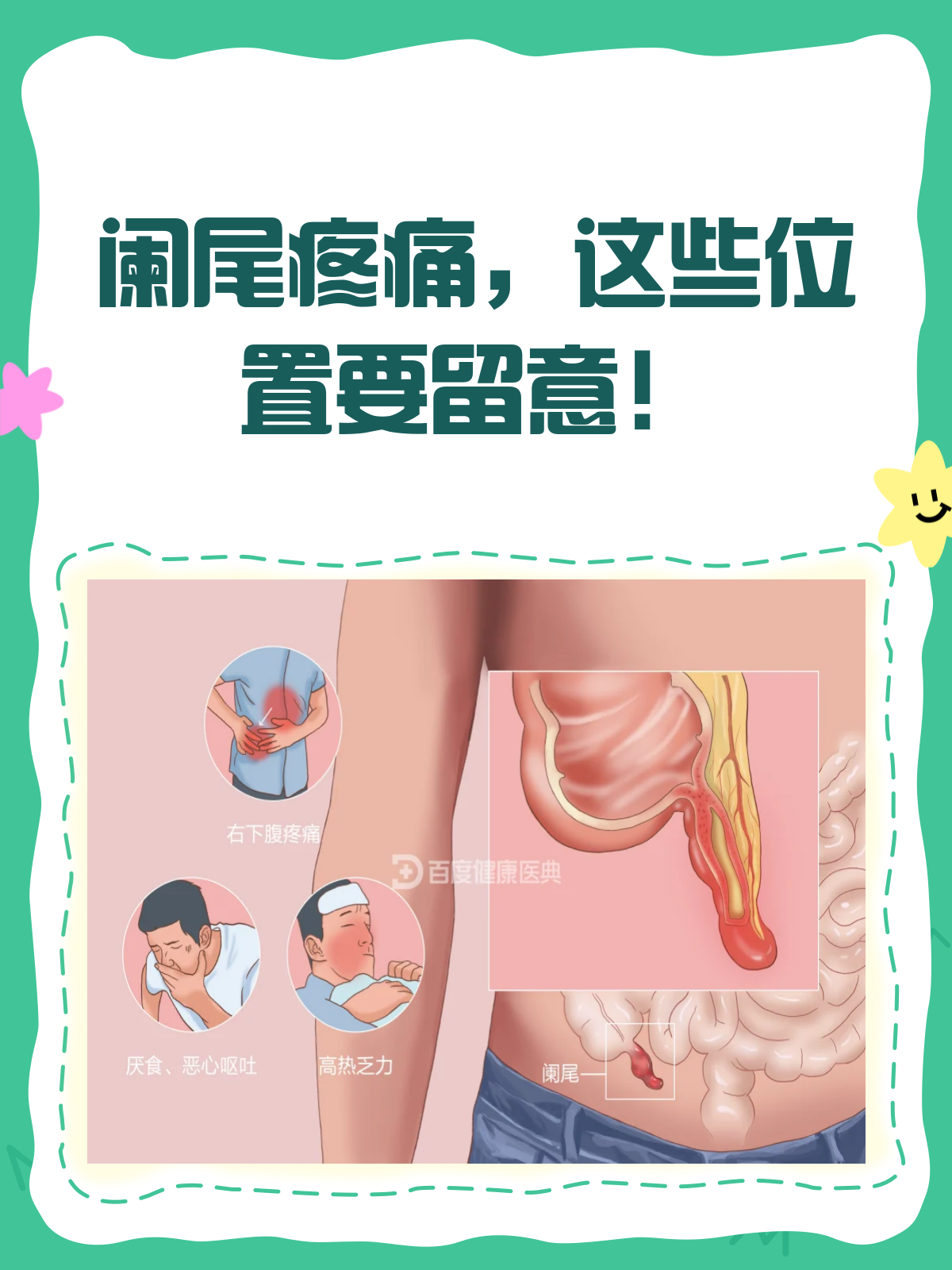 阑尾炎怎么样止痛