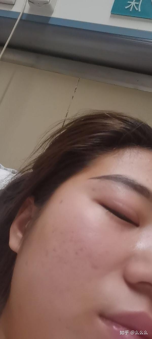 鼻息肉手术后多久恢复