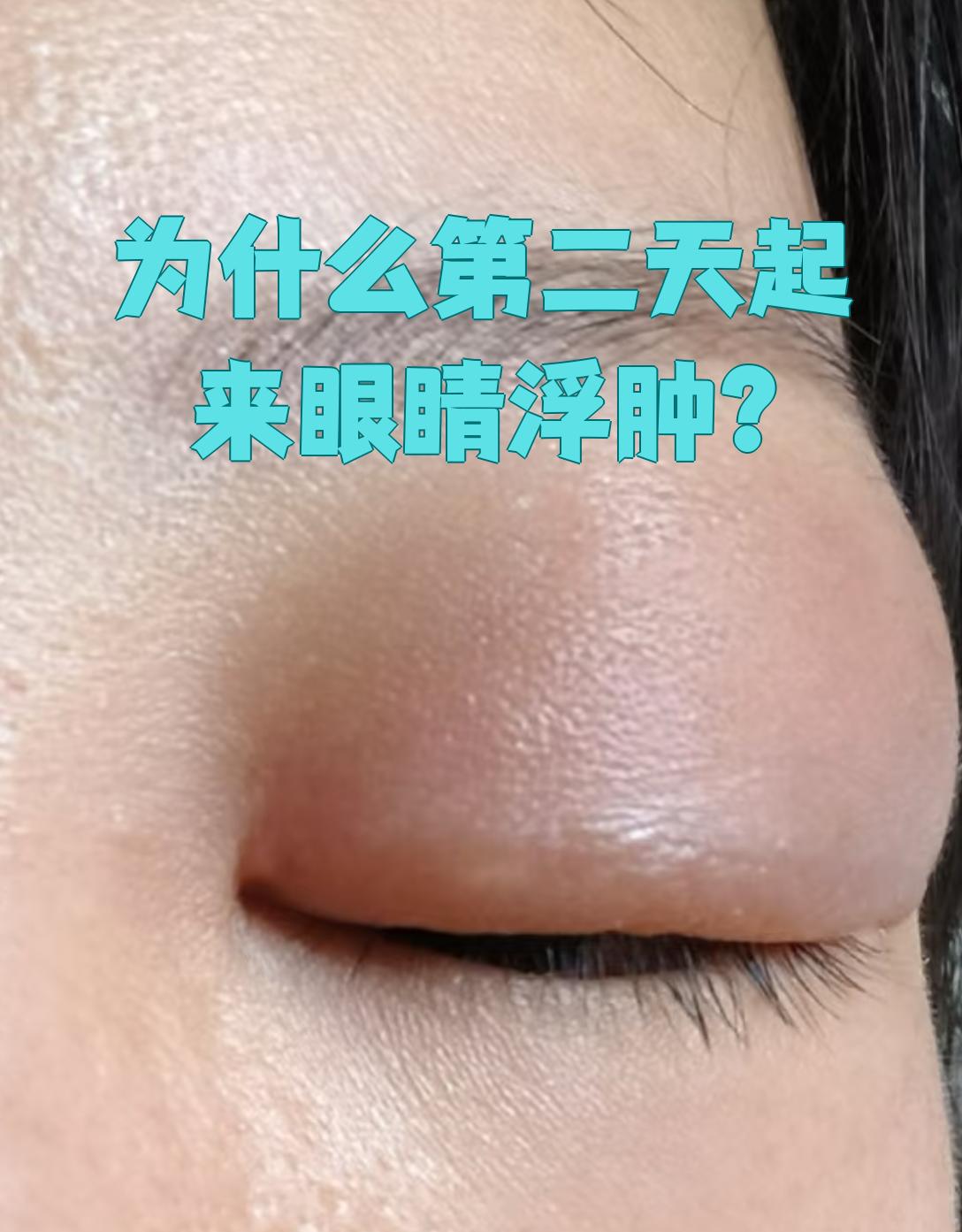 早上起来眼睛肿是怎么回事