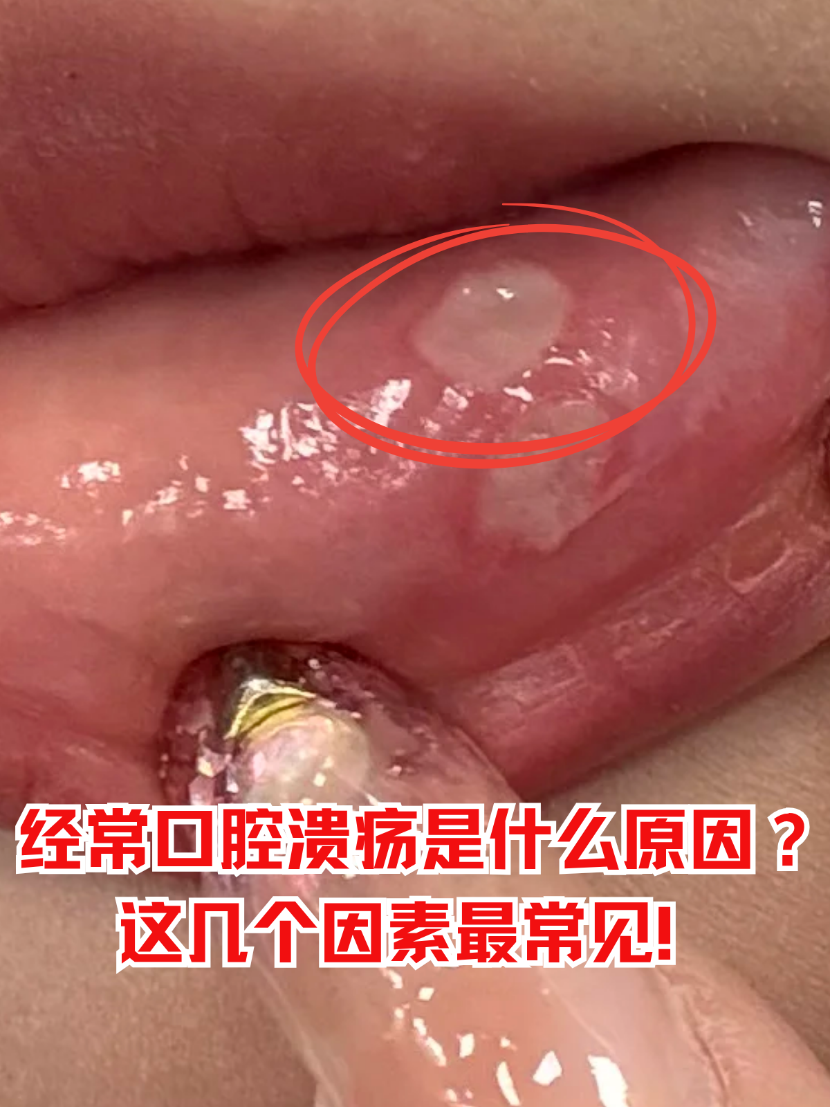 口腔溃疡为什么会反复发生