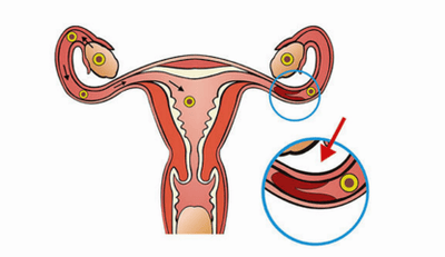 排卵期阴道出血是怎么回事
