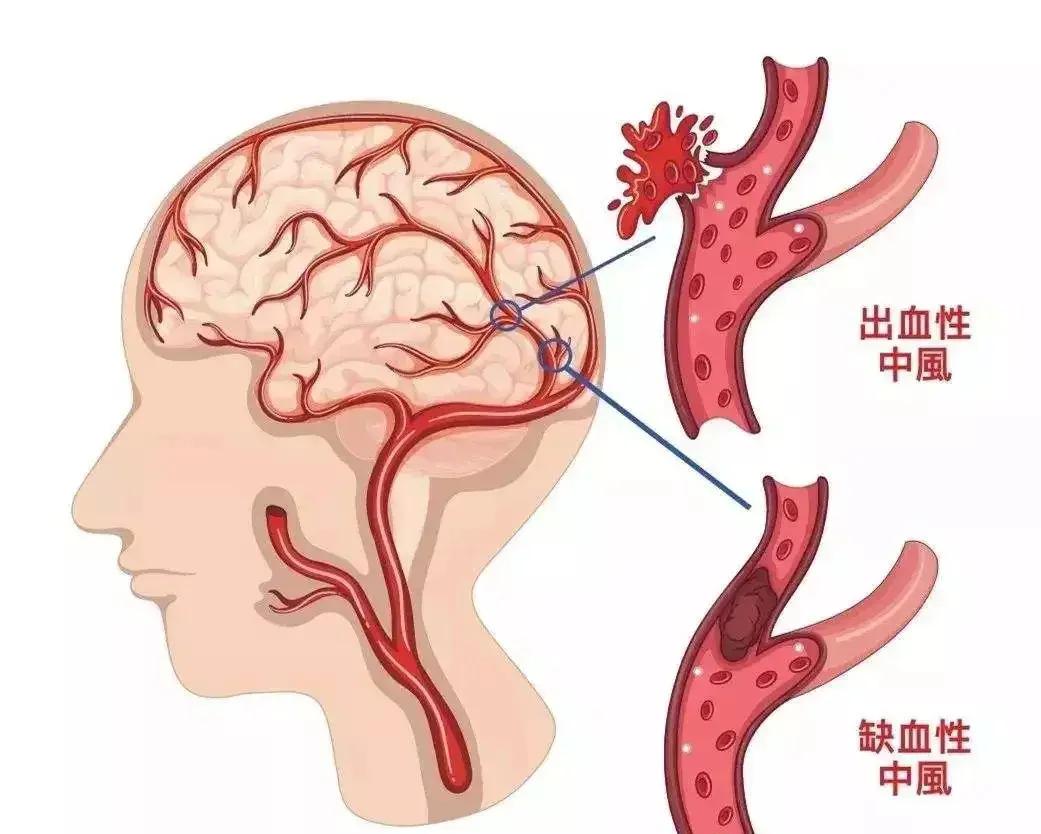 缺氧缺血性脑病的症状