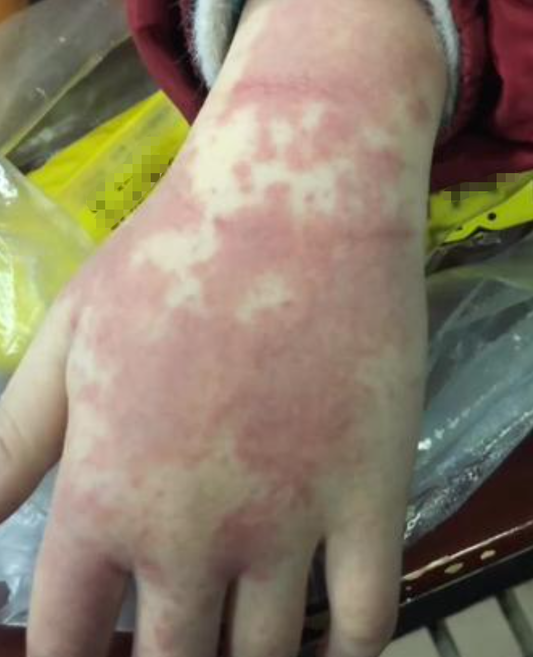 过敏性紫癜能治好吗?