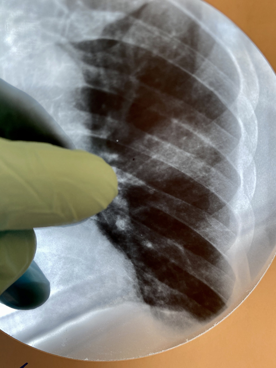 肺结核空洞治疗