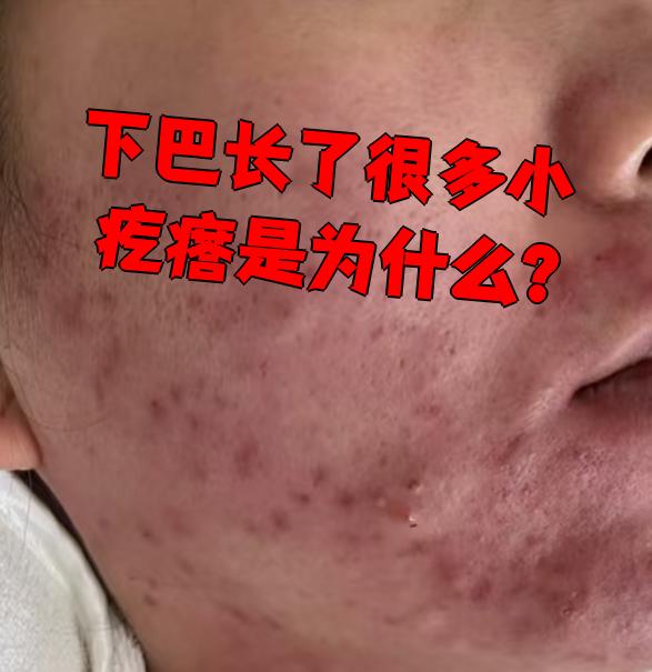 脸上突然长了好多红痘痘
