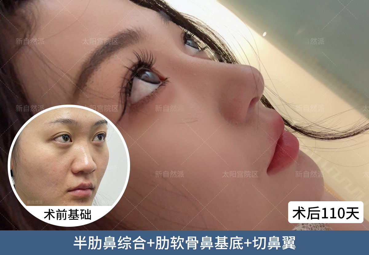 鼻中隔偏曲手术风险