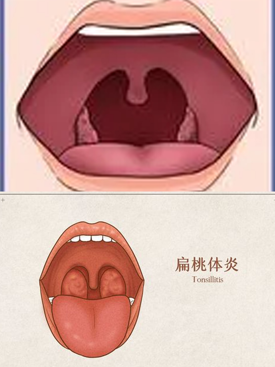 喉咙化脓了怎么办..