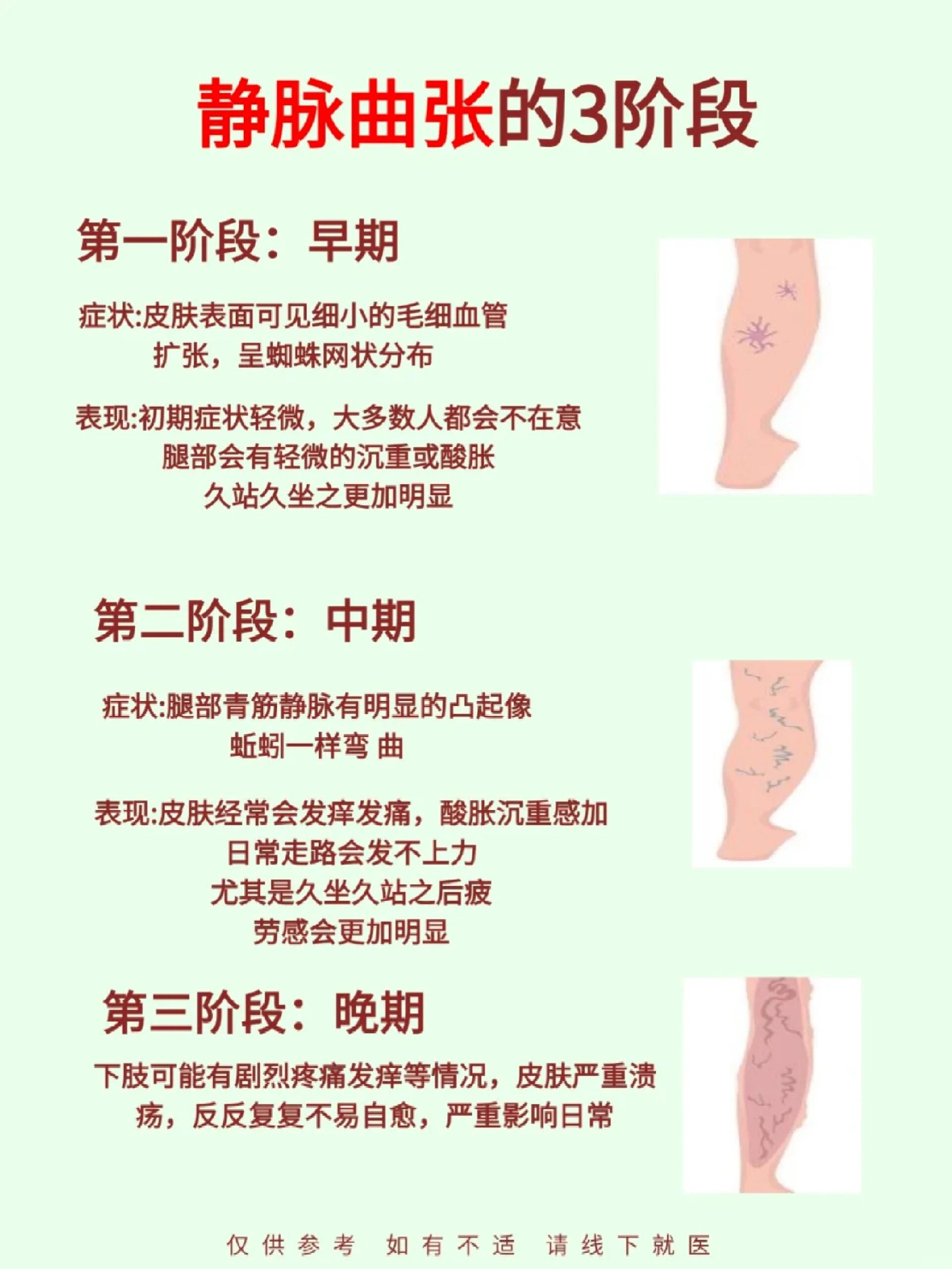 感觉腿上有点青筋怎么回事