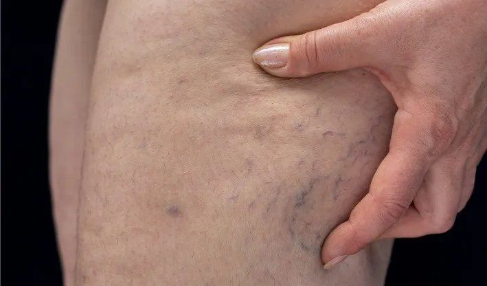 动脉硬化有什么症状表现