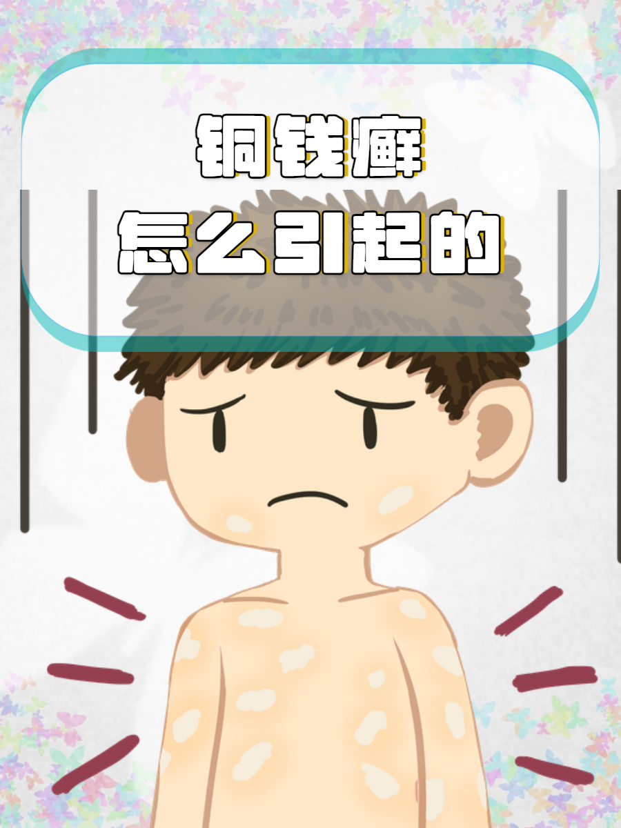 铜钱癣怎么治疗?