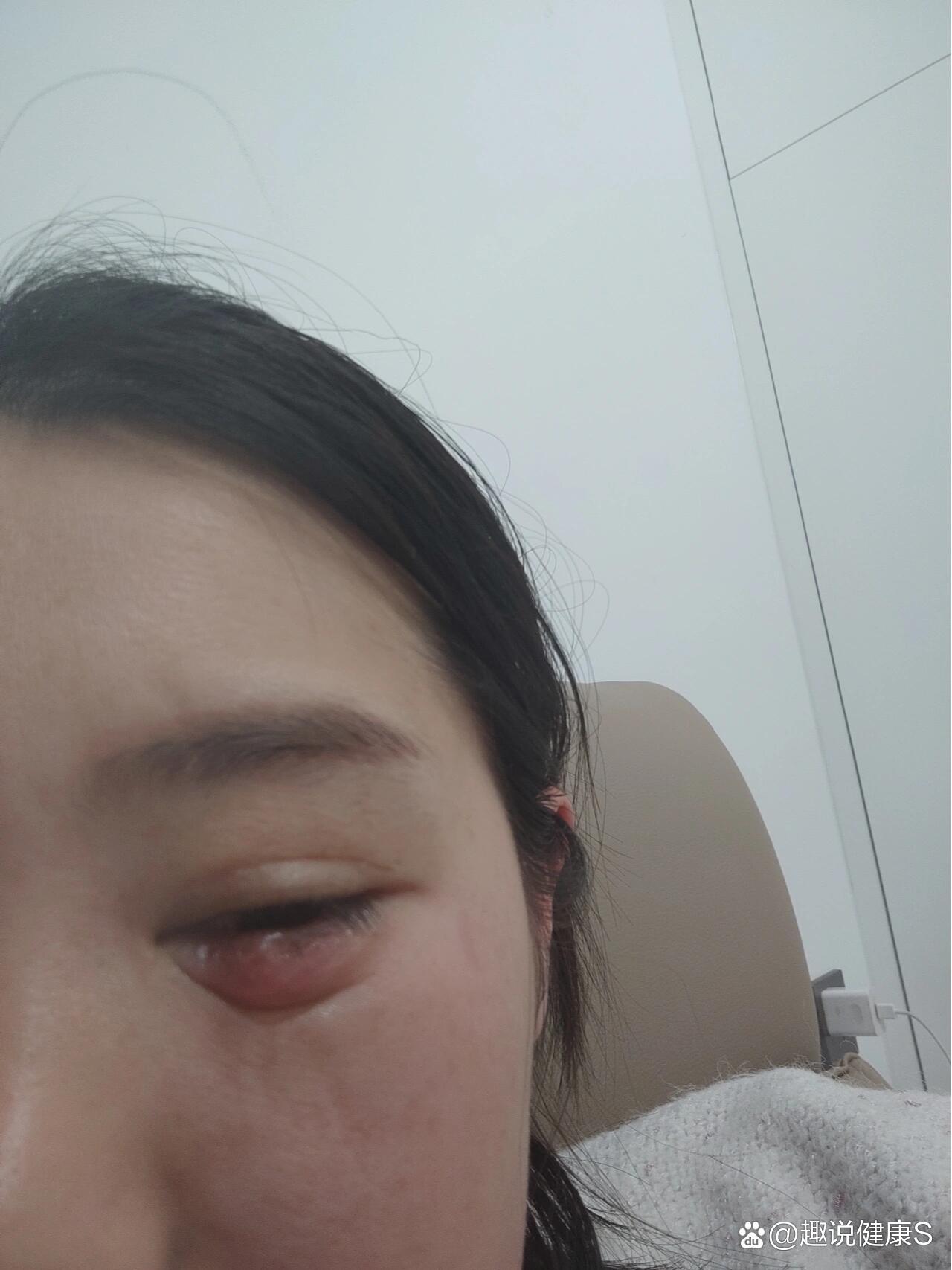 麦粒肿化脓了会自己好吗