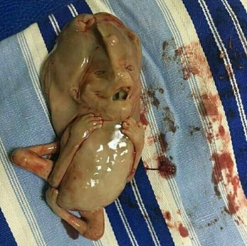 流产没流干净会有什么症状