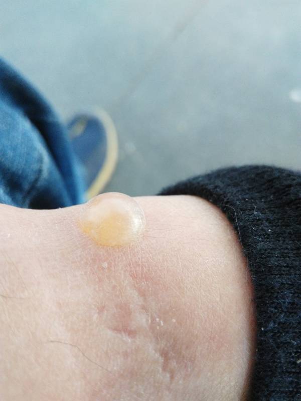 被蚊子咬起水泡,