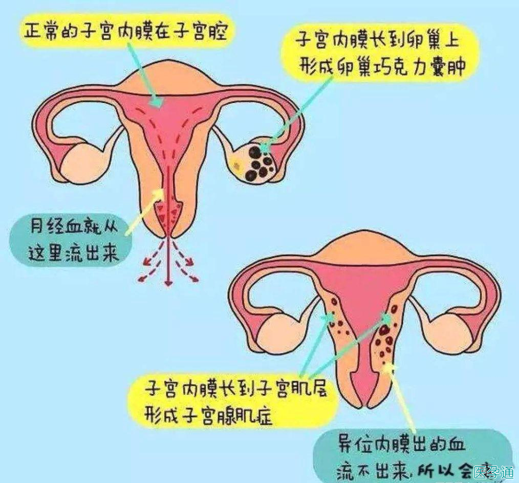 子宫内膜异位症是什么原因造成的