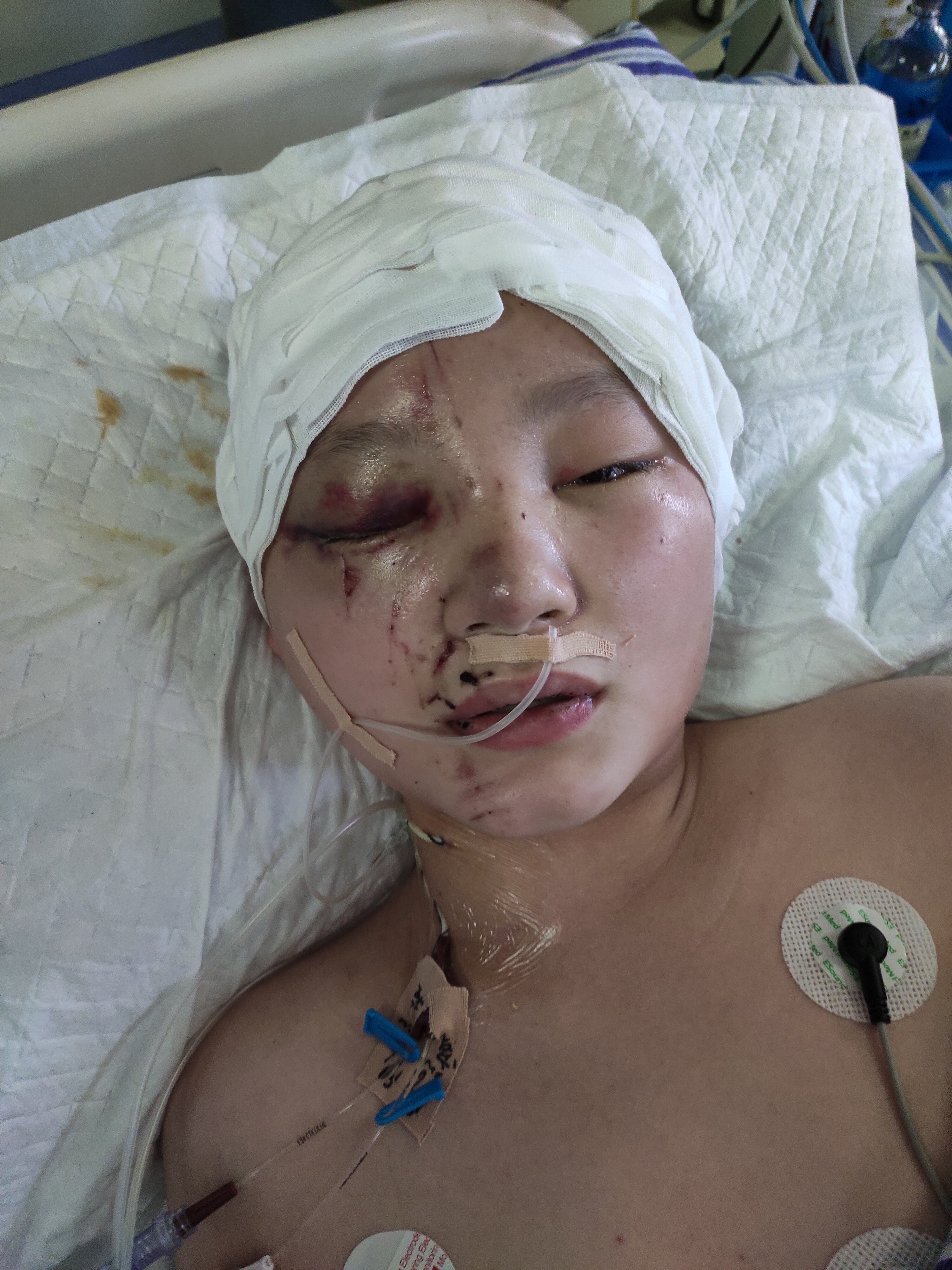 脑挫裂伤的症状