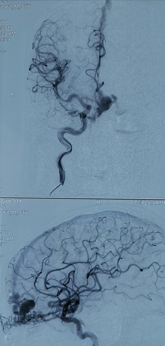 什么是心血管造影