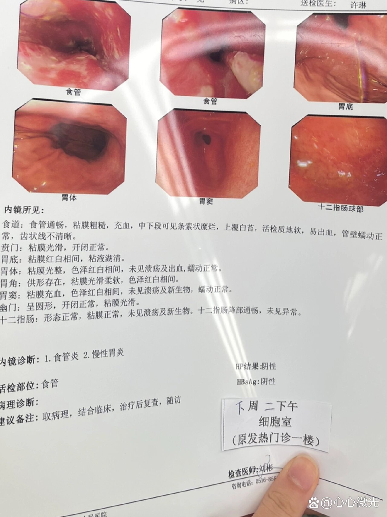 食管炎症状有哪些症状